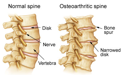 Arthritis Osteoarthritis Spine Comparison