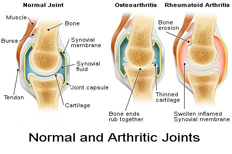 Arthritis Joint Comparison
