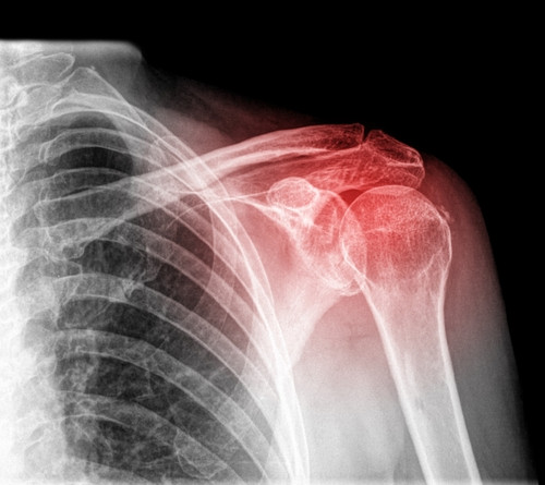 Shoulder Pain - X-Ray