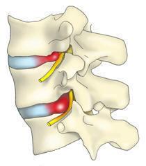 Spinal Disc Injury